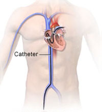 14-right-catheter