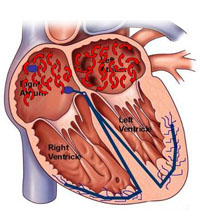 4x-cardioversion