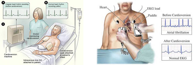 cardioversion3